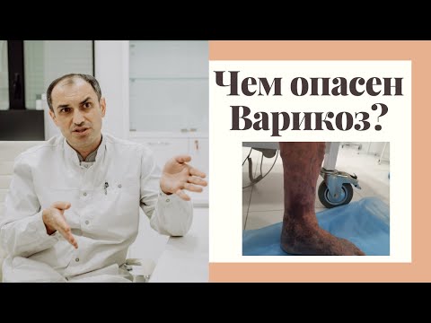 Вот, что будет с ногой если не лечить варикоз. Флеболог Москва.