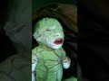 Collodion baby syndrome- congenital ichthyosis, harlequin ichthyosis syndrome, cellophane like membr