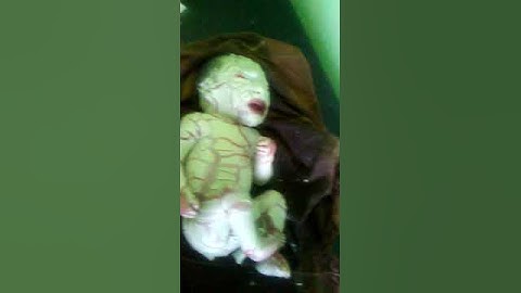 Collodion baby syndrome- congenital ichthyosis, harlequin ichthyosis syndrome, cellophane like membr