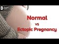 Difference between Ectopic Pregnancy & Normal Pregnancy symptoms - Dr. Archana Kankal