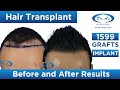 🔥Amazing Hair Transplant Results | Hair Transplant Results Month by Month | 1599 Grafts Implant