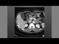 Suprarrenales: Incidentaloma