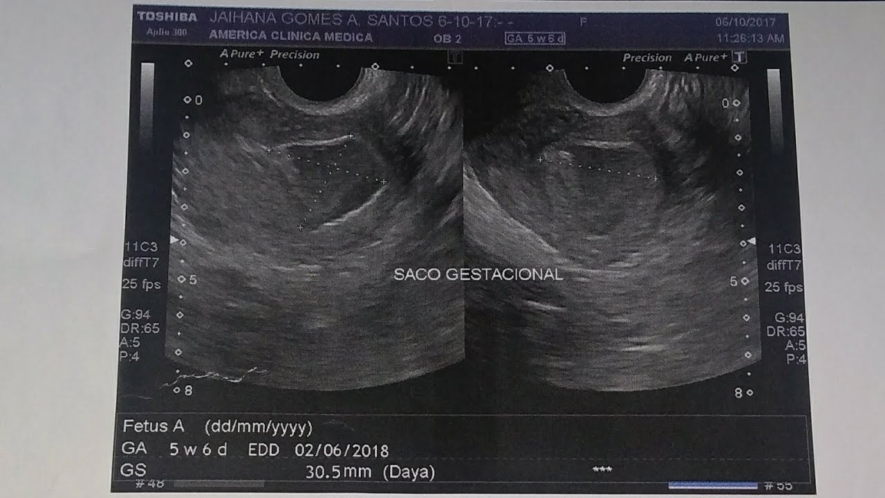 Saco Gestacional Vazio Com 7 Semanas E Normal