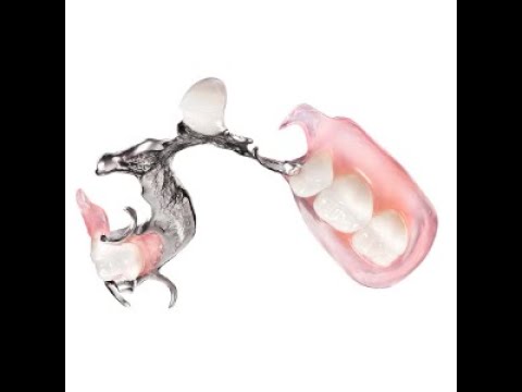 TCS® Unbreakable en combinaison avec une plaque métallique par Dental Connexion