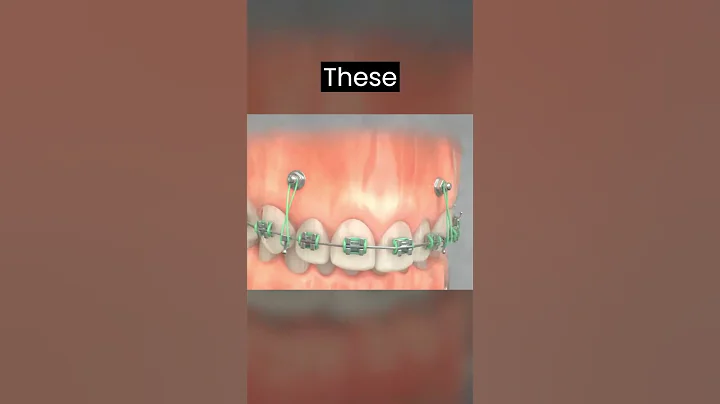 TADs 3 : The next level Orthodontic treatment technique