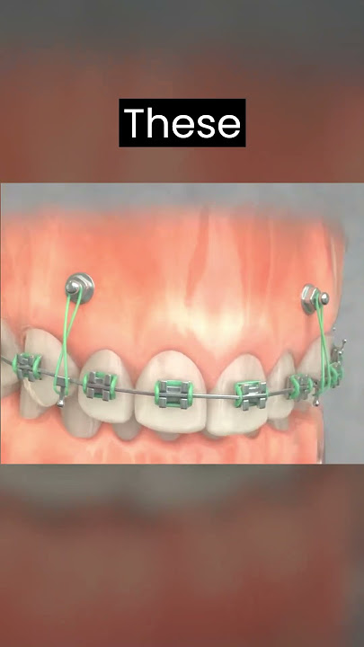 TADs 3 : The next level Orthodontic treatment technique