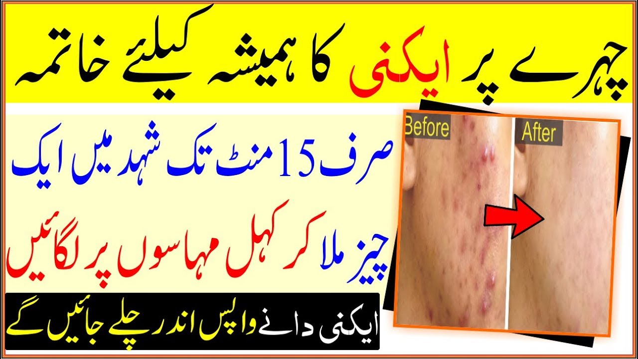 How To Finish Acne Pimples In 15 Minutes Skin Care Tips In Urdu YouTube