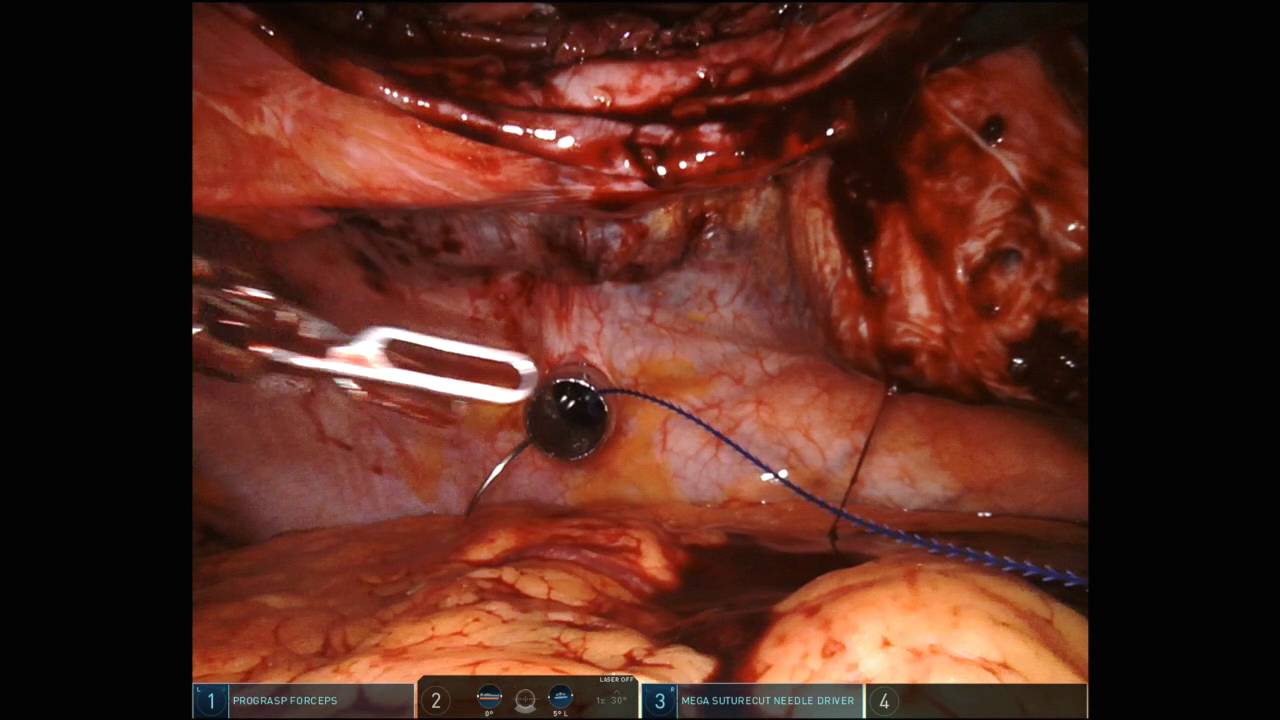 Robotic Paramedian Posterior Rectus Release (RPPRR)