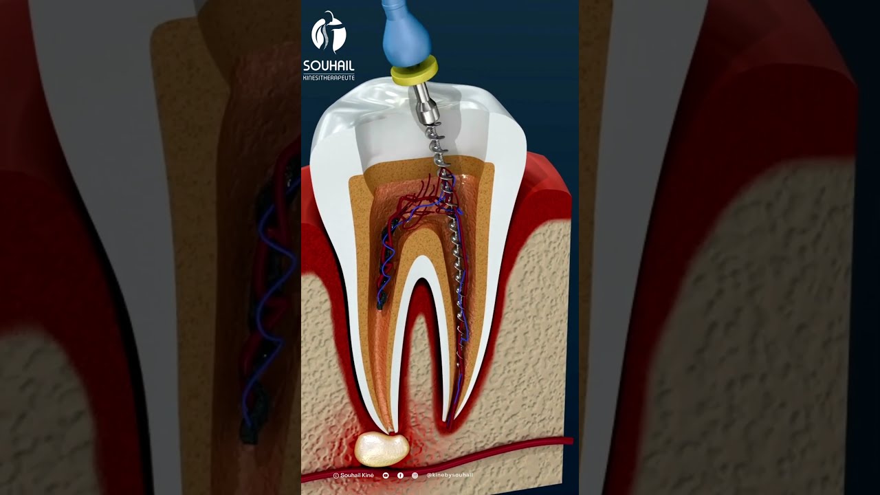Sauvez votre dent atteinte de caries profondes grâce au traitement du canal radiculaire