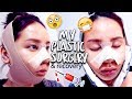 My plastic surgery in korea  vline  rhinoplasty surgery  recovery