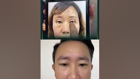 Cắt mí to, mí hỏng phải làm sao | Bác Sỹ Tuấn Dương #shorts