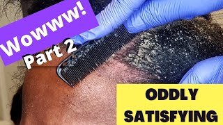 Oddly Satisfying Insane Dandruff Scratching Flakes Scalp Condition  Removal After Braids Pt 2