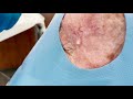 Quick and easy whitehead extraction by dermatologist dr timothy jochen  contour dermatology