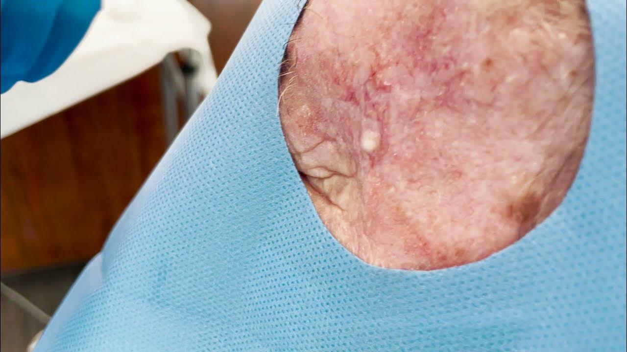 Quick and Easy Whitehead Extraction by Dermatologist Dr. Timothy Jochen