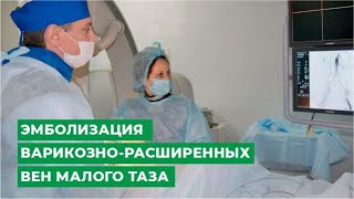 Эмболизация варикозно-расширенных вен малого таза