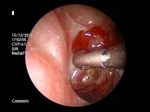 What is Sinusitis?. 