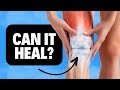 Can the Meniscus Tear in Your Knee Heal On Its Own? Knee Cartilage