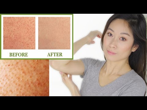 Indian Home Remedies For Keratosis Pilaris Indian Home Remedies For Keratosis Pilaris