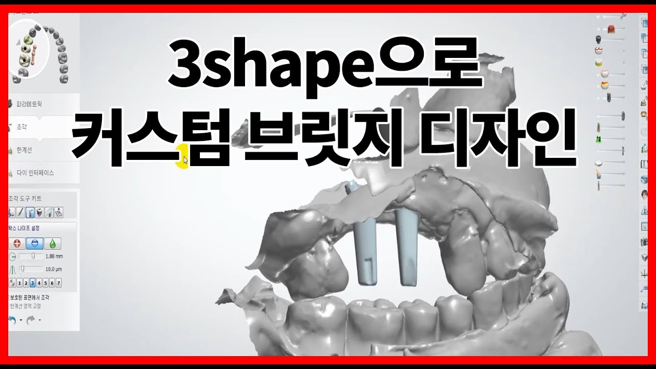 3shape으로 커스텀 브릿지 디자인 하는 방법 abutments design 치기공 - YouTube