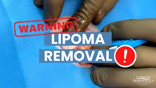 Dermatologist Squeezes Out A Lipoma | CONTOUR DERMATOLOGY