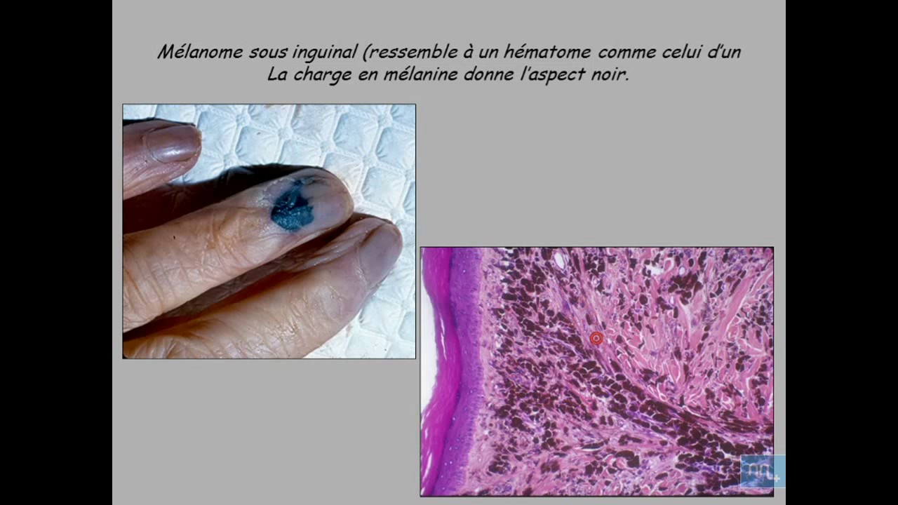 Tumeurs Généralités partie 4 YouTube Tumeurs Généralités partie 4 YouTube