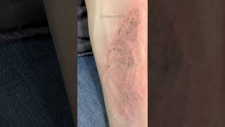 Removing tattoos with picosecond laser☄️#shorts