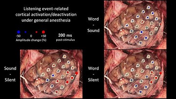 cortiQ Rapid Cortical Mapping under Anestesia