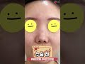 [작은코성형] 코가 작고 콧볼이 넓어 결정한 코수술 솔직한 후기