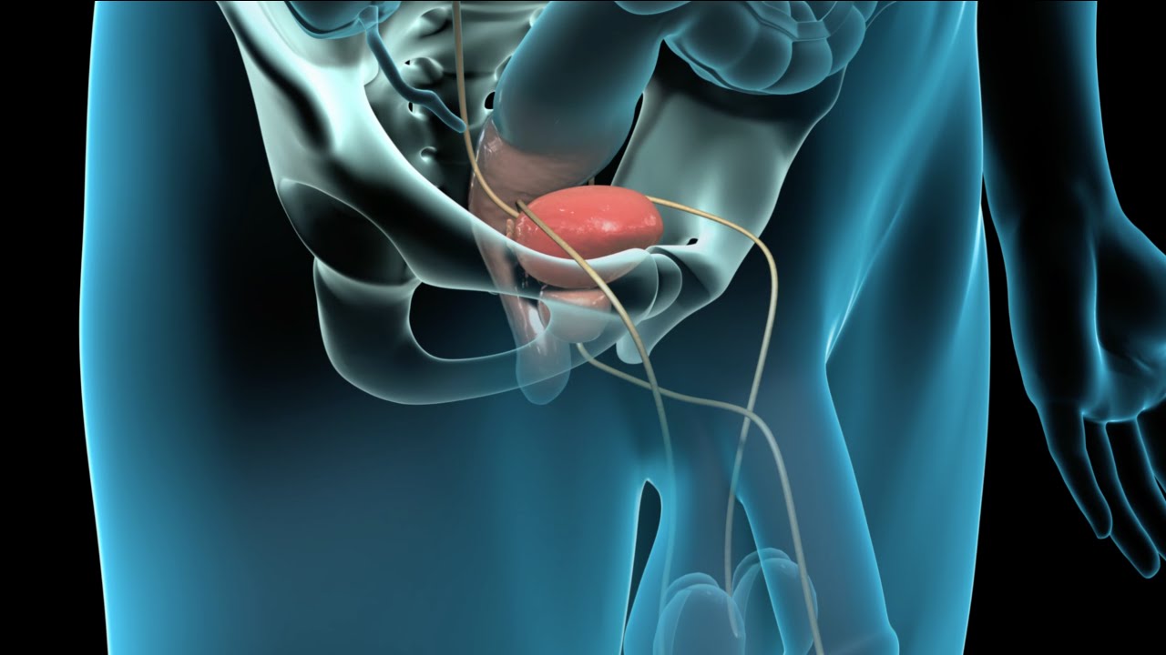 prostatectomia radical laparoscopica)