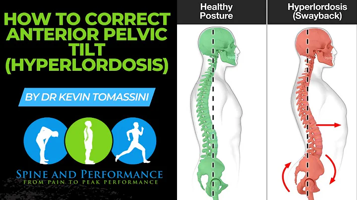 How to Correct Anterior Pelvic Tilt (Hyper Lordosis)