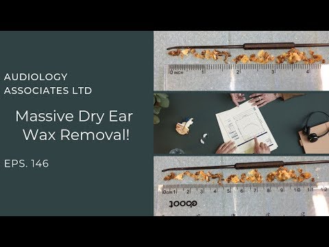MASSIVE DRY EAR WAX REMOVAL - EP 146