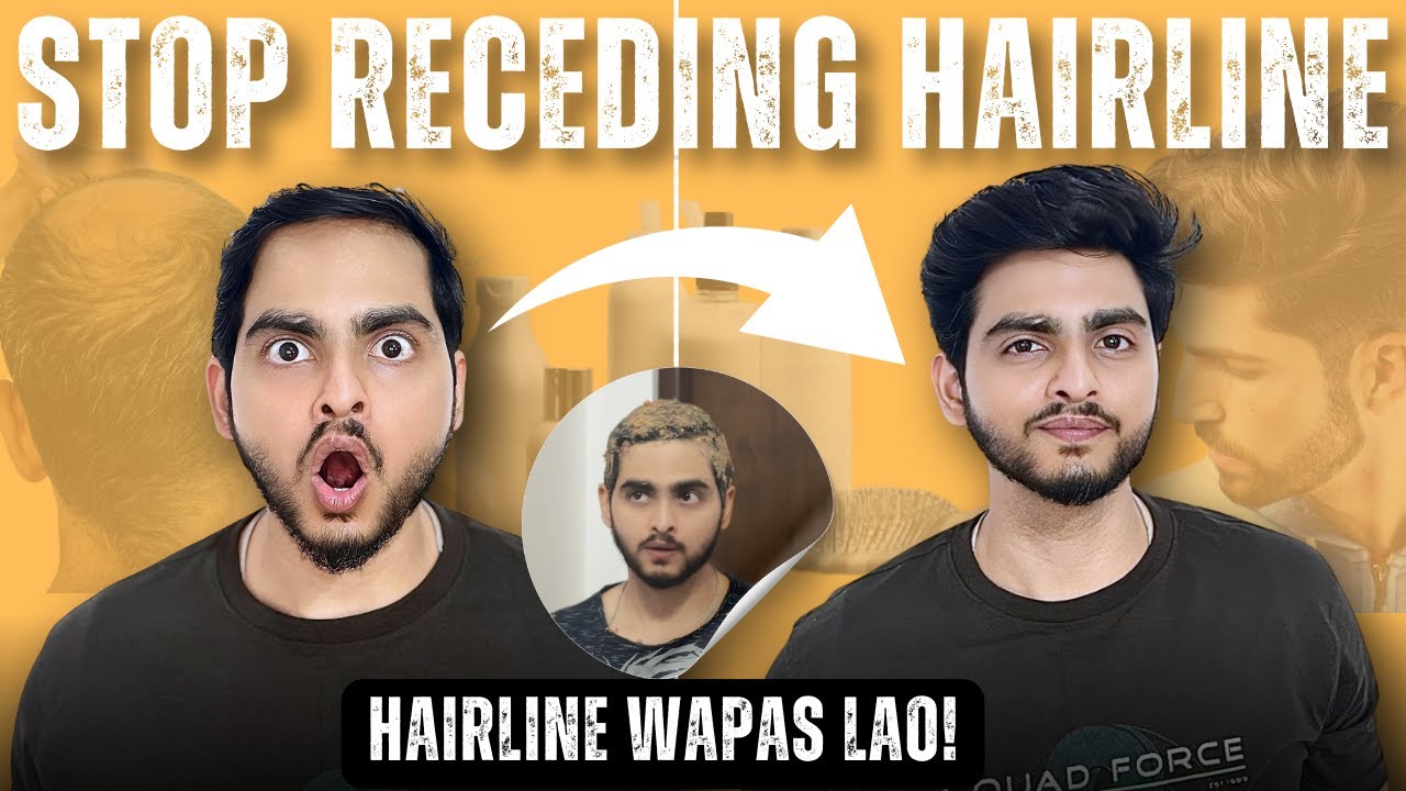 How to Actually Fix a Receding Hairline