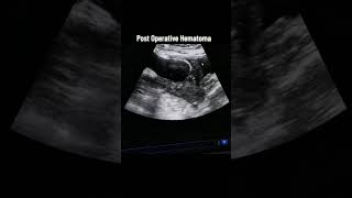 post operative hematoma ultrasound scanning#pregnancyultrasound#hematair#viralvideo#shortsvideo