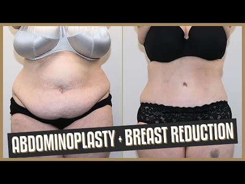 Tummy Tuck (Abdominoplasty) and Breast Reduction