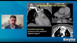The Sniper Technique | Part 1: Patient Selection and Pre-Procedural Planning
