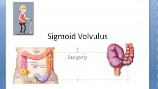 Surgery 747 Sigmoid Volvulus OMEGA coffee bean Bird beak Ogilvie Northern Hartmann Emergency