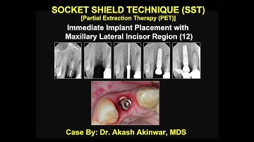 Socket Shield Technique Surgical Phase By Dr  Akash Akinwar, MDS
