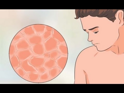 Infecciones bacterianas vs micóticas de la piel de la ingle