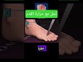 تنمل مع حرارة القدم تنمل مع حرارة القدم