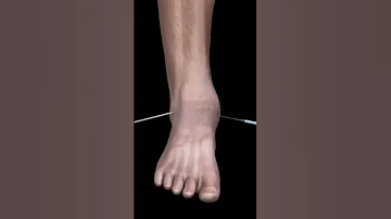 جراحة مفصل القدم Foot Joint Surgery 