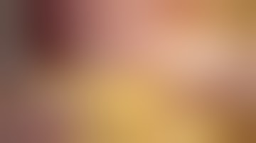 Laparoskopik Parsiyel Nefrektomi(Laparoscopic partial nephrectomy) - Posterior kitle (Dr.Evren SÜER)