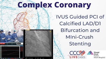 IVUS Guided PCI of Calcified LAD/D1 Bifurcation and Mini-Crush Stenting