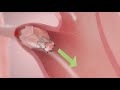 How it works zephyr endobronchial valve