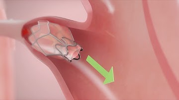 How It Works: Zephyr Endobronchial Valve