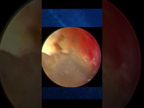 شكل حصوات الكلى بمنظار تنظير الك لى جرح صغير لا يتعدى ١سم لإستخراج حصوة ك لى تتعدى ال٥ سم