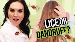 Dandruff or Head Lice? How to tell the Difference