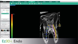 Ez3D-i Endo