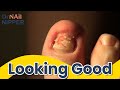 Do thick toenails hurt?  Nervous Patient with Dr Nail Nipper {Throwback]