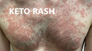 Say Bye Keto Rash - How I Solved It