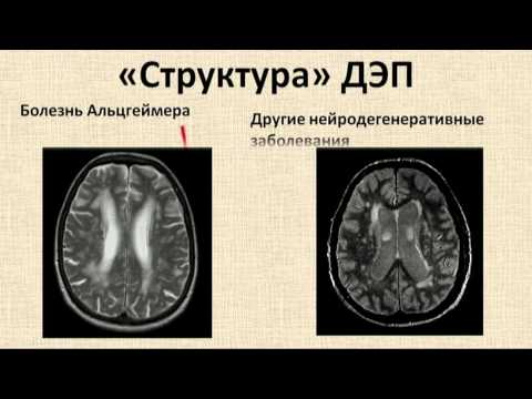 Video: Encefalopatija - Discirkulatorna Encefalopatija